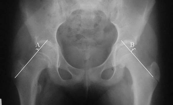 FIGURE 1. Measurement methods on an anterior-posterior radiograph of a right slipped capital femoral epiphysis. White lines indicate Klein        s line for each hip. A and B, indicate maximum epiphyseal width lateral to Klein        s line. As B is 2mm greater than A, the left hip qualifies as a slip using our modification but not Klein        s original definition.
