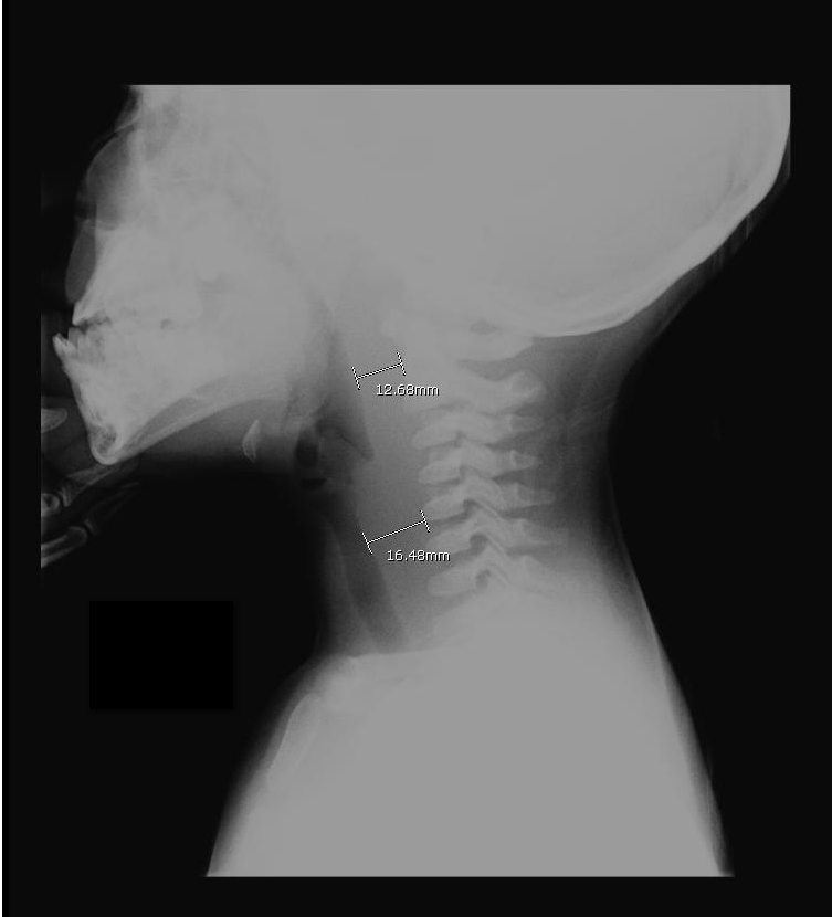 Deep Throat X Ray 73