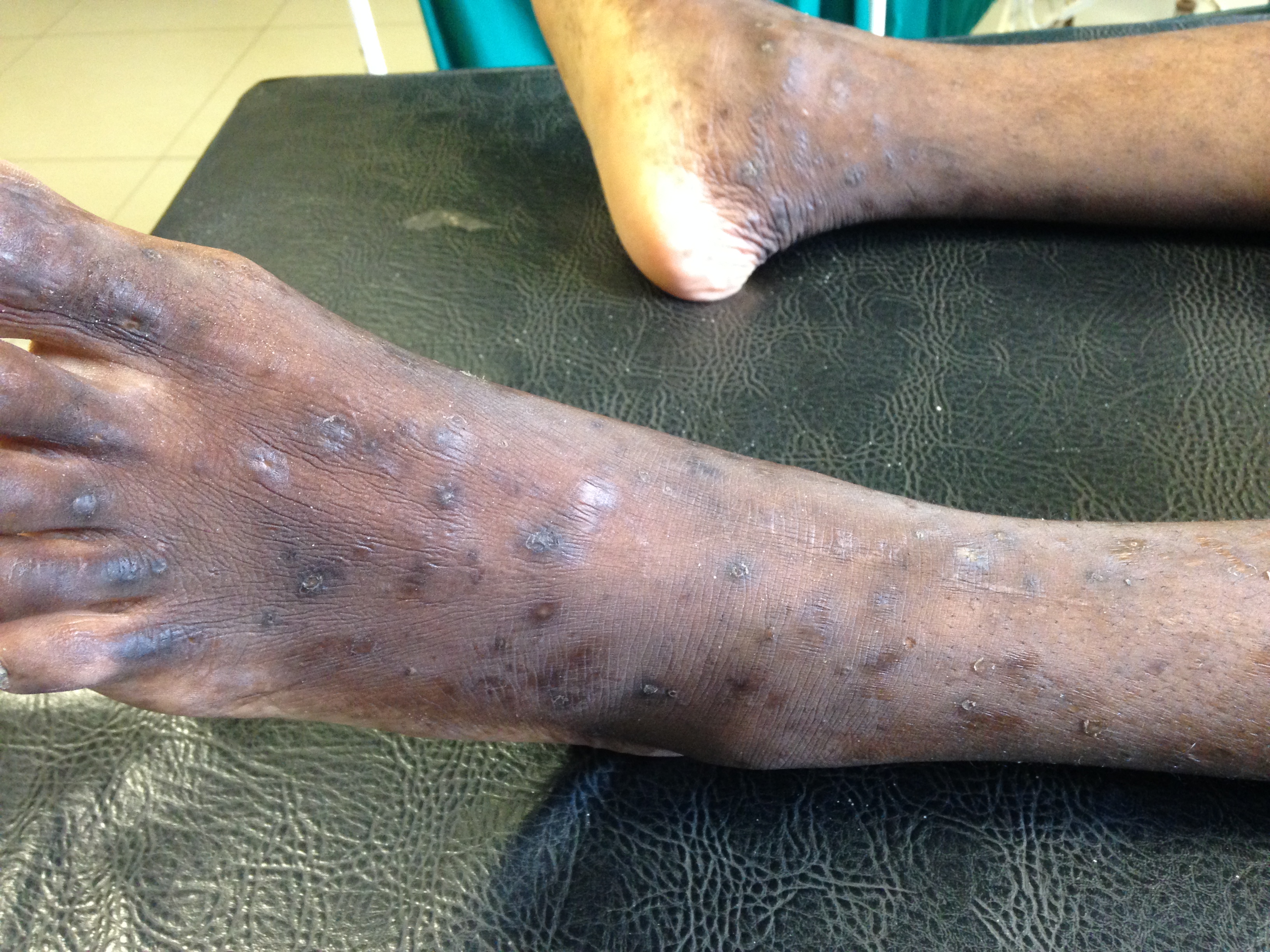 hiv rash feet