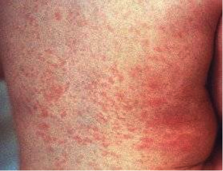 Chikungunya Rashes Chikungunya Rashes