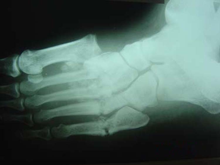 Charcot Joint