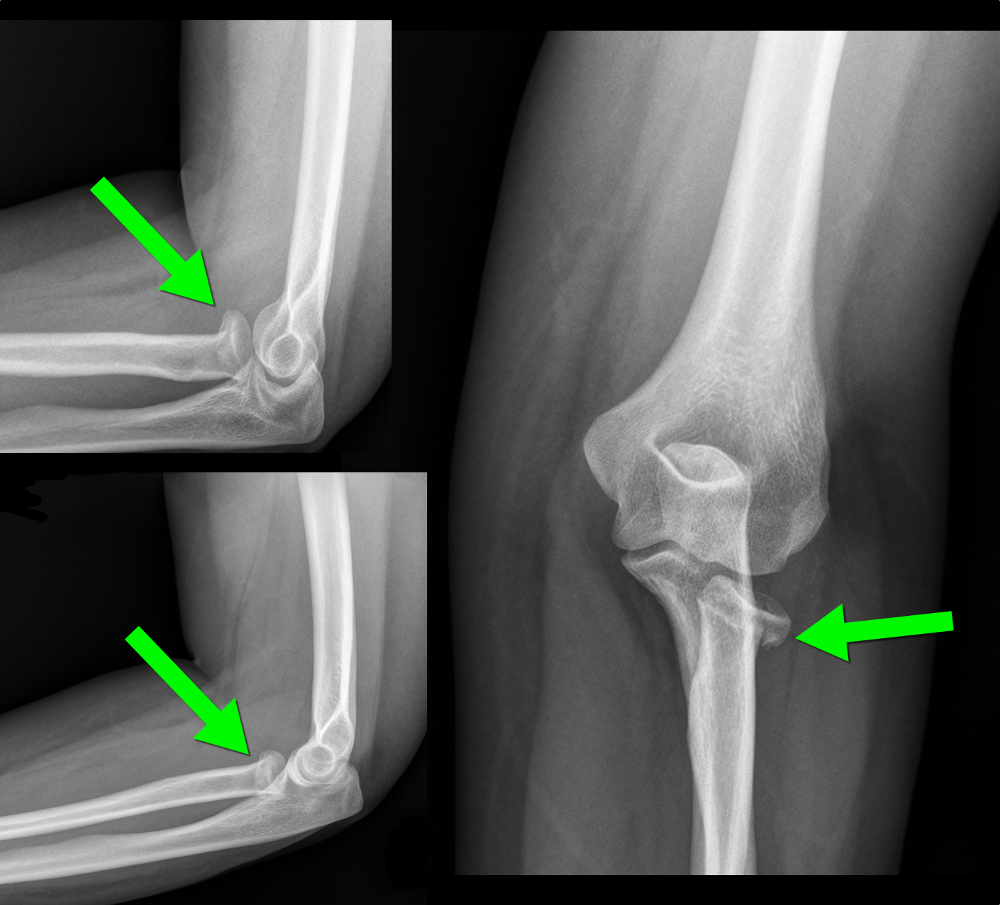 radial head fracture